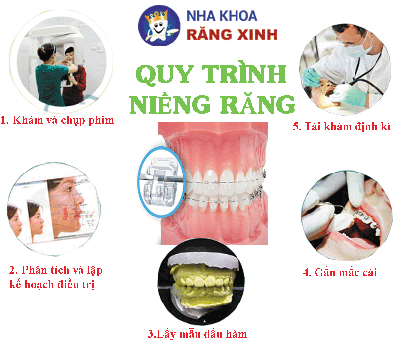 chi phí niềng răng nha khoa Nghệ An