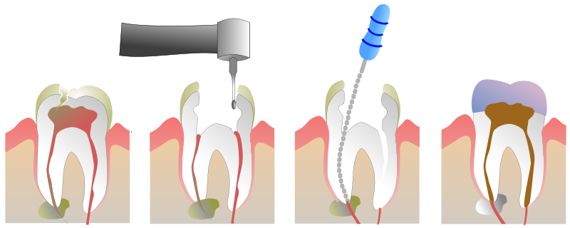 chữa tủy răng uy tín