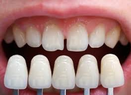 bọc răng sứ nguyên hàm