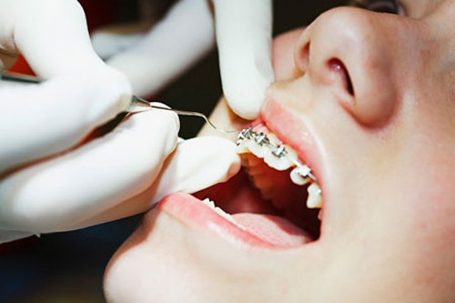 quy trình niềng răng chuẩn nhất