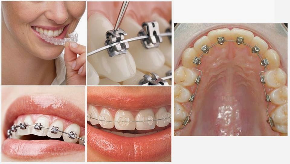 quy trình niềng răng chuẩn nhất