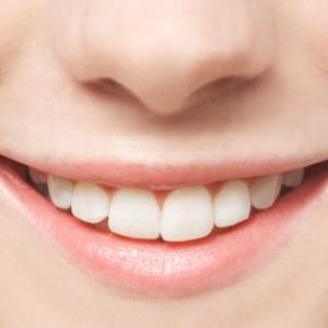 Bọc răng sứ mang lại những lợi ích gì