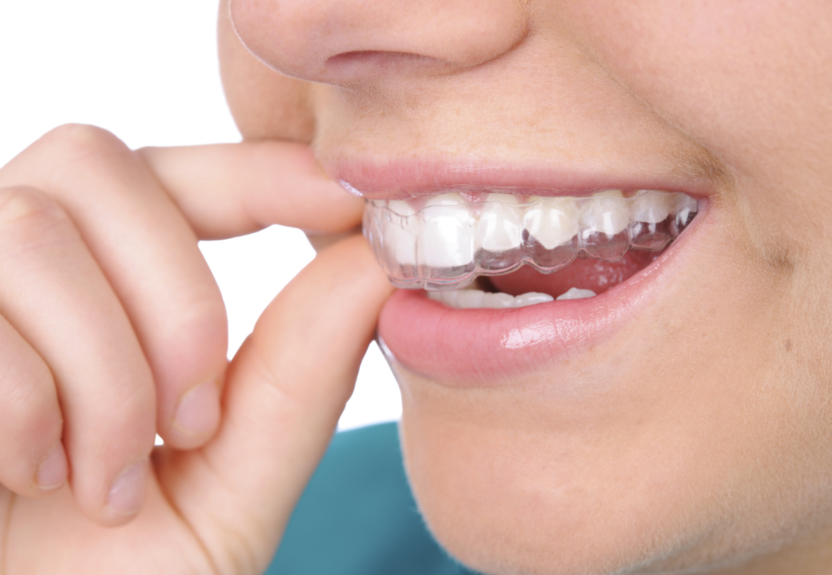 Niềng răng không mắc cài Invisalign hiệu quả như thế nào