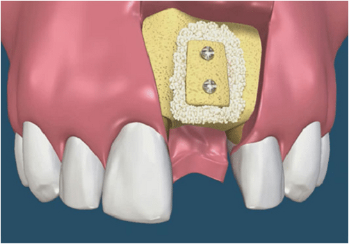 ghép xương răng