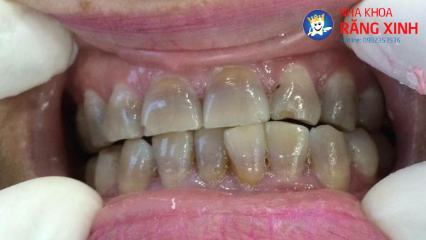 Răng bị nhiễm kháng sinh