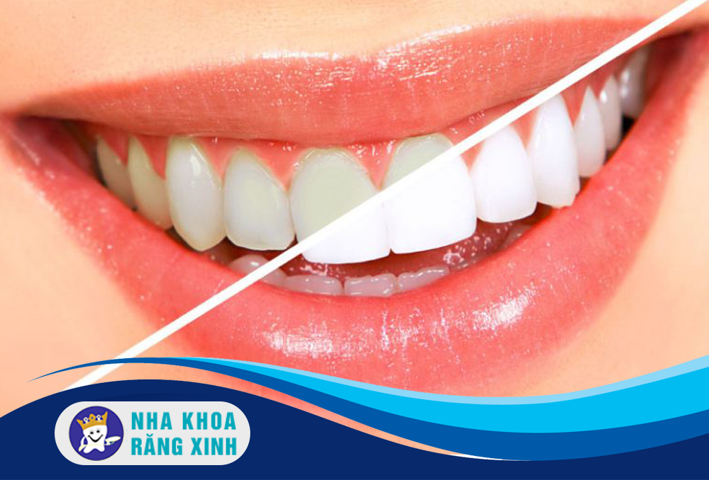 tẩy trắng răng hiệu quả ở đâu tại vinh