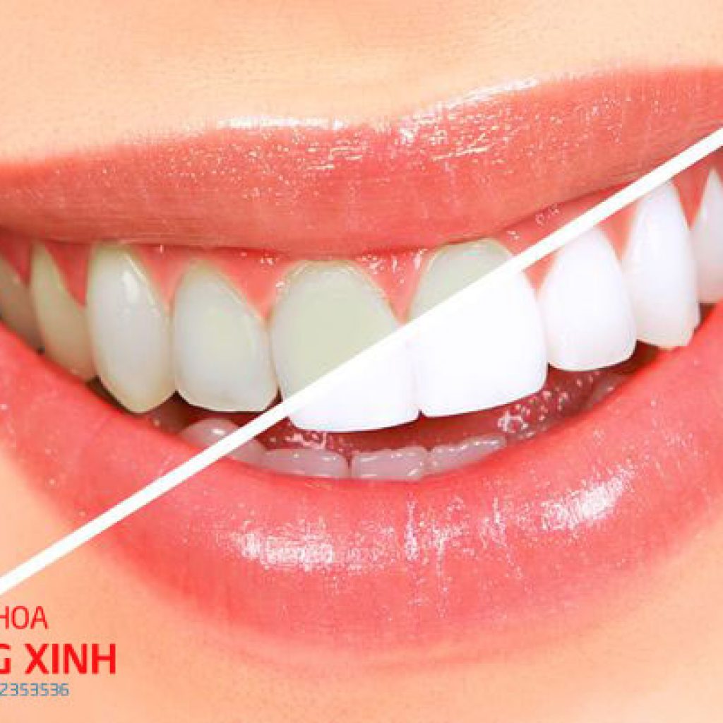 bat mi 5 cach tay trang rang tai nha đon gian